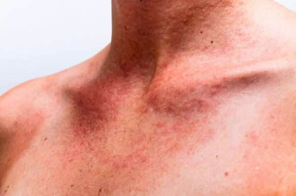 Rash cutáneo: qué es, causas, síntomas y tratamiento - Causas del rash cutáneo