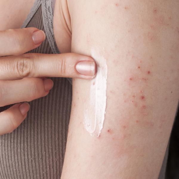 Dermatitis atópica: síntomas, causas y tratamiento