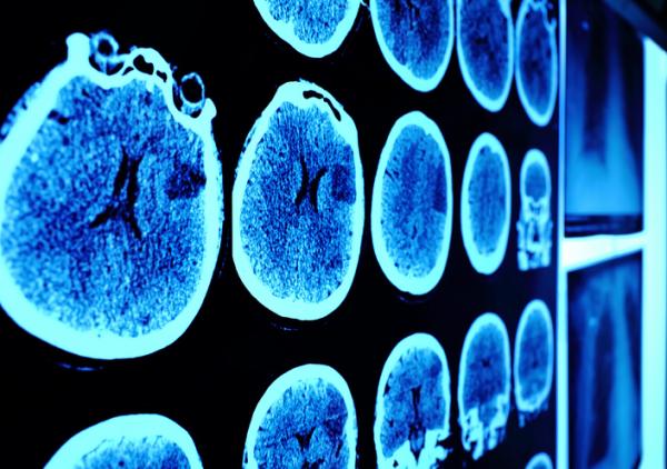 Meningioma: síntomas, tratamiento y secuelas