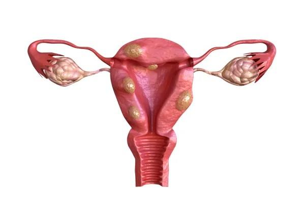  Desde que me puse el DIU no dejo de sangrar: ¿Es normal?  - Causas del sangrado prolongado con el DIU