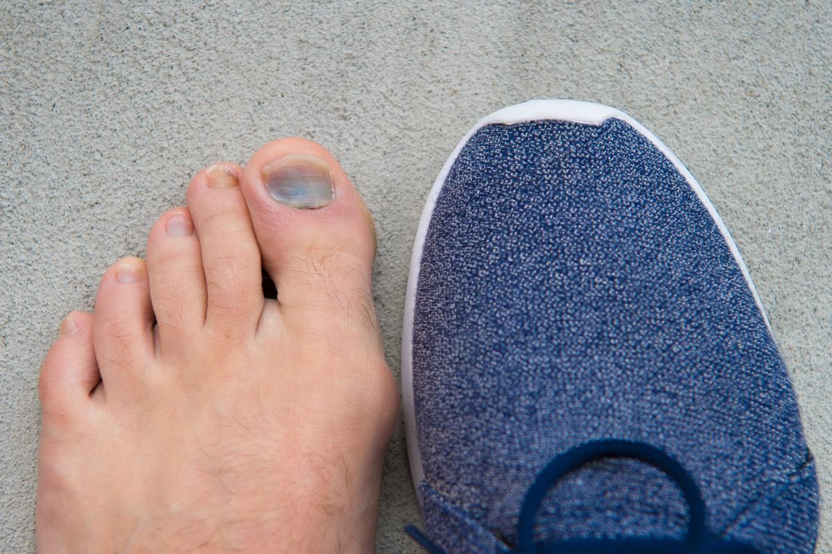 Por qué se caen las uñas de los pies y qué hacer