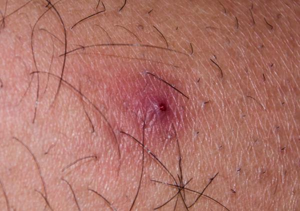 Remedios caseros para la foliculitis