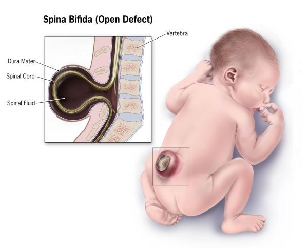 Espina bífida: tipos, causas, síntomas y tratamiento - Espina bífida abierta o quística