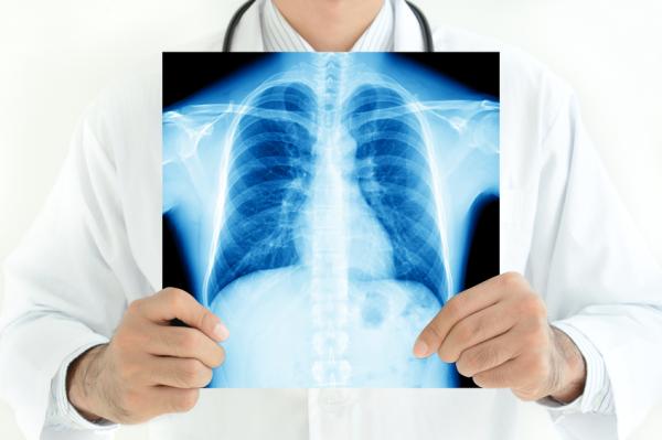 Manchas en los pulmones: causas y síntomas - Qué significa cuando hay una mancha en el pulmón