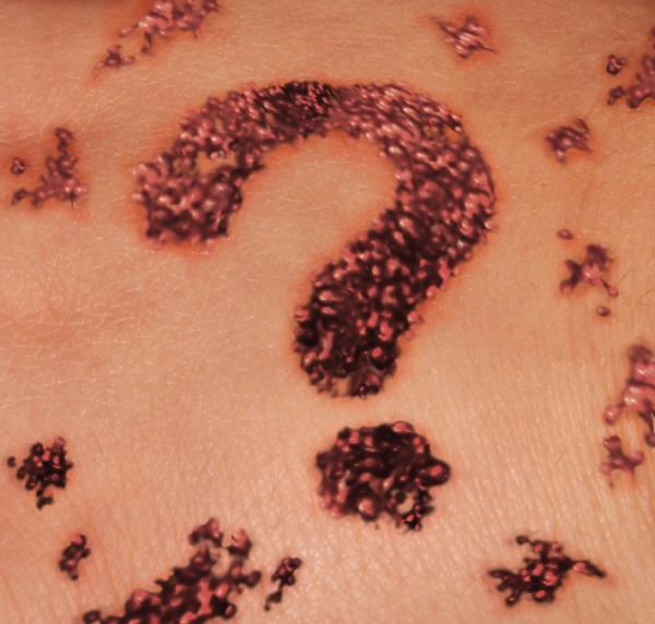 Cáncer de piel: síntomas y tratamiento - Síntomas del cáncer de piel