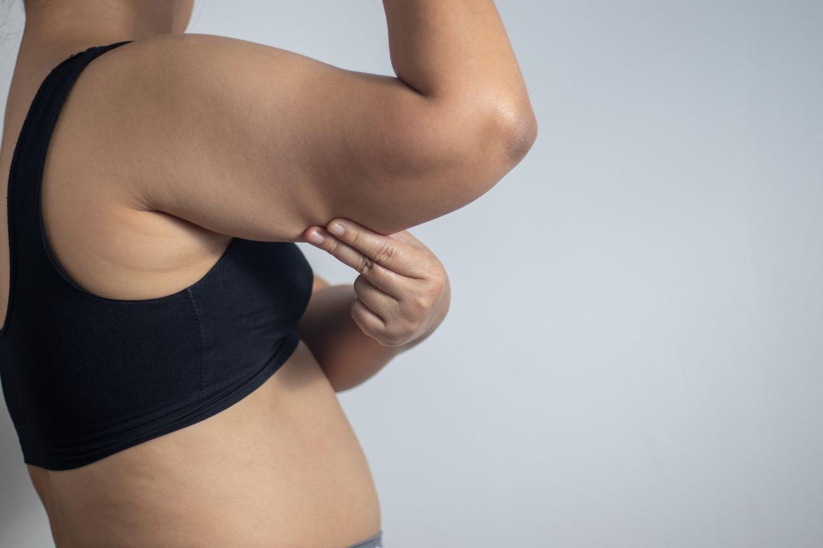 Lipedema en brazos: síntomas, causas y tratamiento