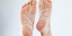 Durezas en los pies: por qué salen, cómo quitarlas y remedios caseros