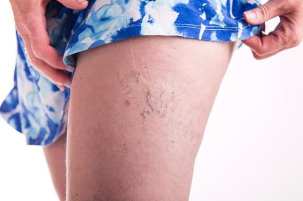 Remedios caseros para las varices - ¿Por qué se producen las varices?