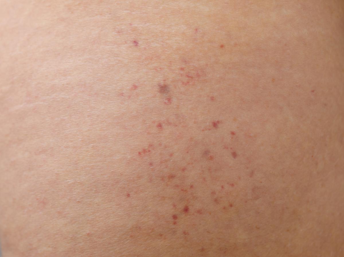 Petequias en las piernas: causas y tratamiento