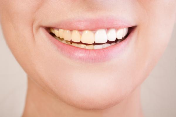 Alimentos que blanquean los dientes - ¿Por qué se manchan los dientes?