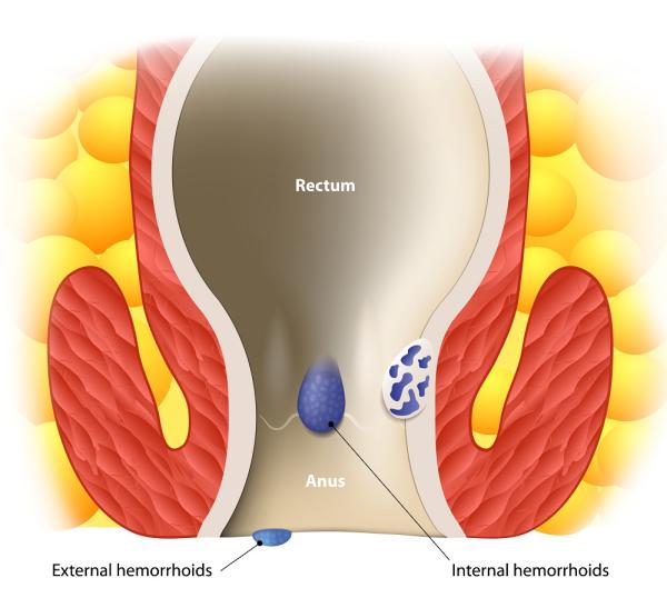 Cómo desinflamar las hemorroides externas rápidamente - Hemorroides externas: síntomas