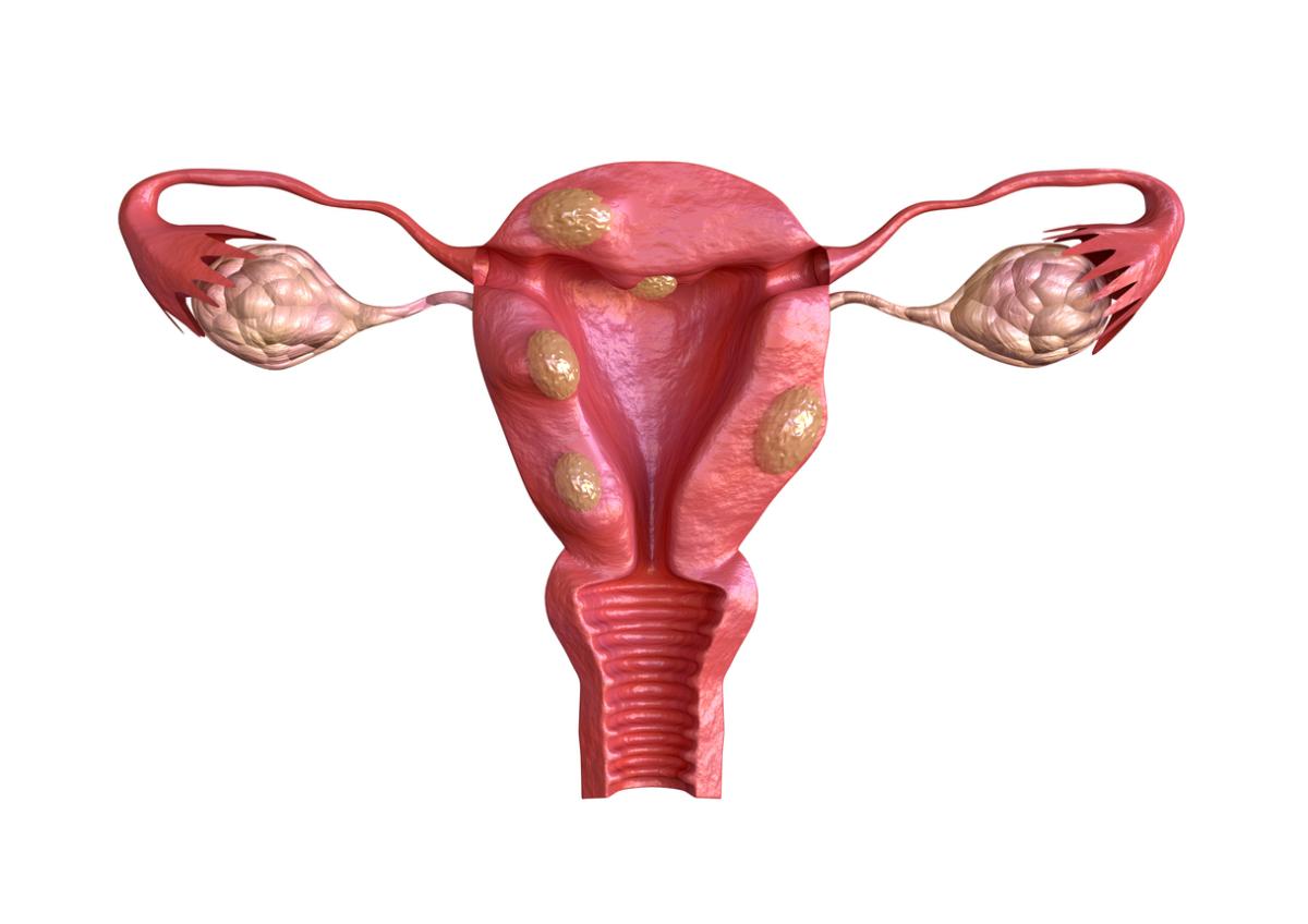 ¿Tener miomas uterinos engorda?