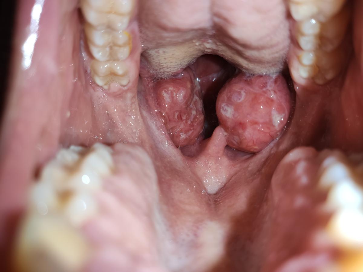 Por qué salen placas de pus en la garganta y cómo curarlas