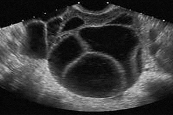 Embarazo molar: causas, síntomas y consecuencias - con fotos - Cómo detectar un embarazo molar – diagnóstico