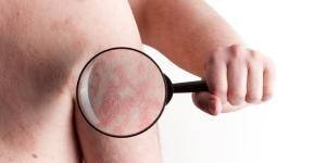 Remedios caseros para la psoriasis