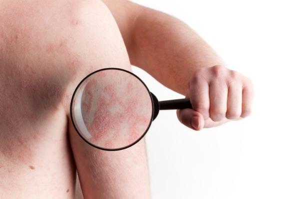Remedios caseros para la psoriasis