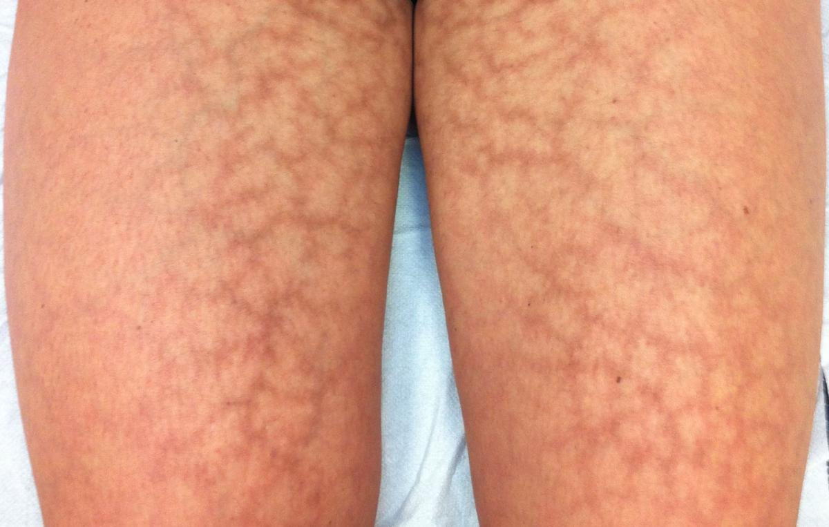 Por qué salen cabrillas en las piernas y cómo eliminarlas