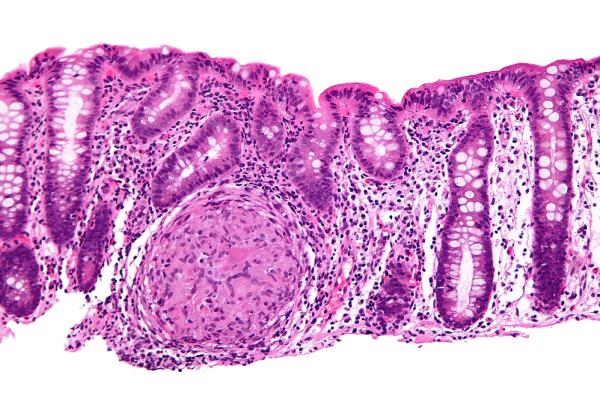 Enfermedad de Crohn: síntomas y tratamiento