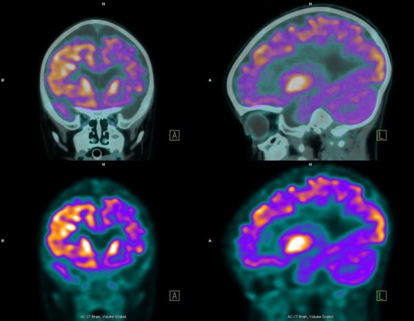 Epilepsia: síntomas, causas y tratamiento