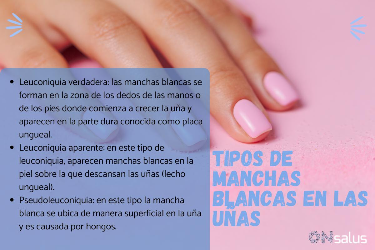 Manchas blancas en las uñas: causas y tratamiento