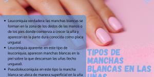 Manchas blancas en las uñas: causas y tratamiento