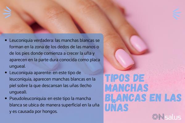 Manchas blancas en las uñas: causas y tratamiento