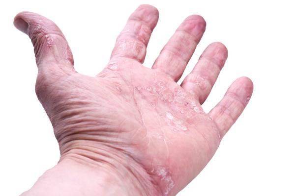 Cremas naturales para la psoriasis