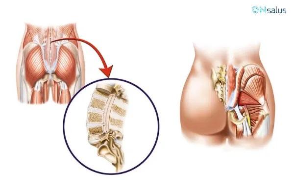 Hormigueo en la planta del pie: causas y tratamiento - Ciática inflamada