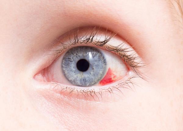 Conjuntivitis: tipos, síntomas y tratamiento - Síntomas asociados a la conjuntivitis