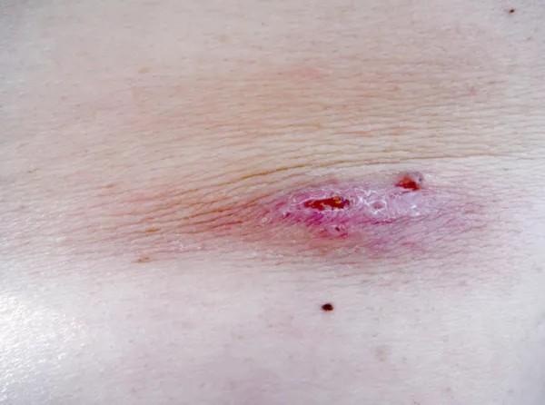 Bulto interno en la axila con dolor: causas y tratamiento - Forunculosis