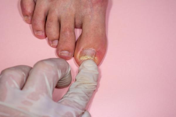 Cómo curar una uña levantada del pie