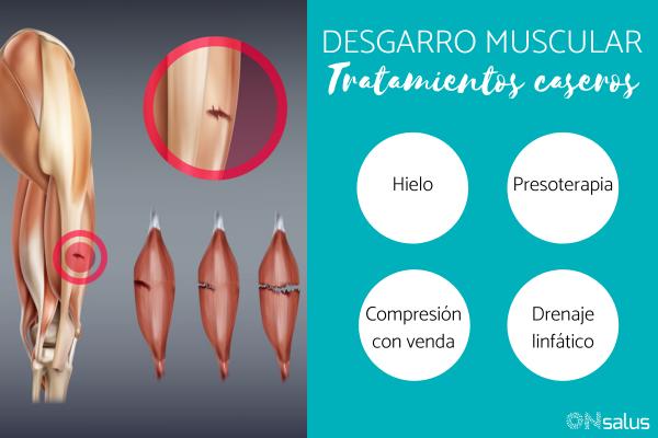 Tratamiento casero para el desgarro muscular