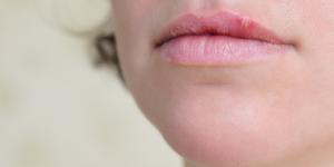 ¿El herpes labial tiene cura definitiva?