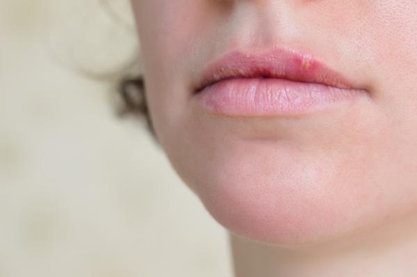 ¿El herpes labial tiene cura definitiva?