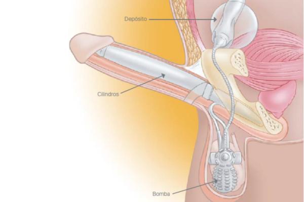 Cómo son las relaciones sexuales para los hombres con una prótesis de pene - Transparencia y comunicación