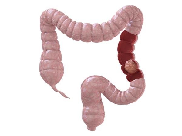 Diverticulitis: causas, síntomas y tratamiento