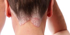 Sarpullido en la cara y cuello: causas y tratamiento