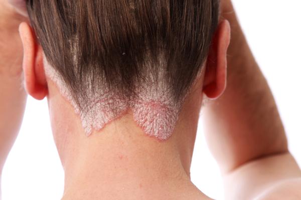 Sarpullido en la cara y cuello: causas y tratamiento