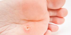 Clavos en los pies: causas y cómo quitarlos