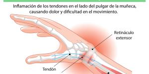 Tenosinovitis: qué es, causas, síntomas y tratamiento
