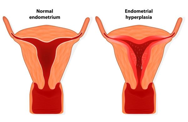 Cáncer de endometrio: causas, síntomas y tratamiento