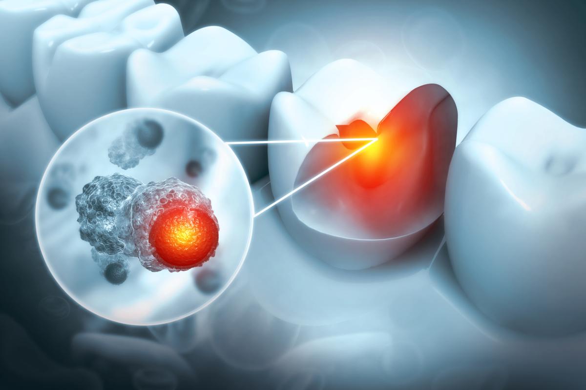 ¿Se puede sacar una muela con infección?