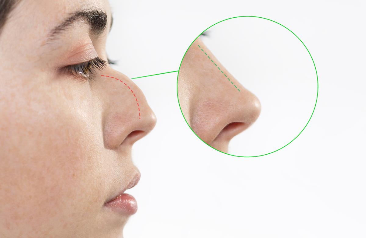 Rinoplastia: qué es y por qué es importante para tu salud