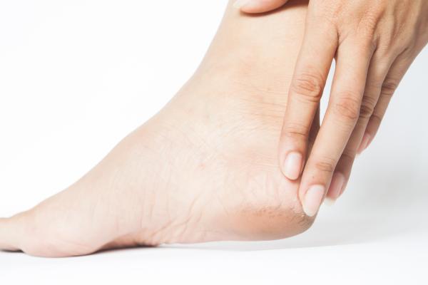 ¿Cómo curar grietas profundas en los talones? - Síntomas y causas más comunes de las grietas en los pies