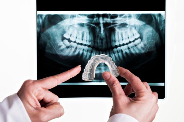 Abfracción dental: qué es y tratamiento - Causas de la abfracción dental