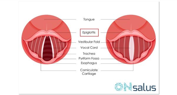 Epiglotitis aguda: síntomas y tratamiento - Causas de la epiglotitis aguda
