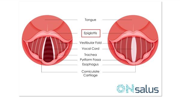 Epiglotitis aguda: síntomas y tratamiento - Causas de la epiglotitis aguda