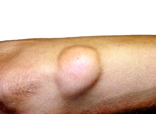 Lipoma maligno: causas, síntomas y tratamiento