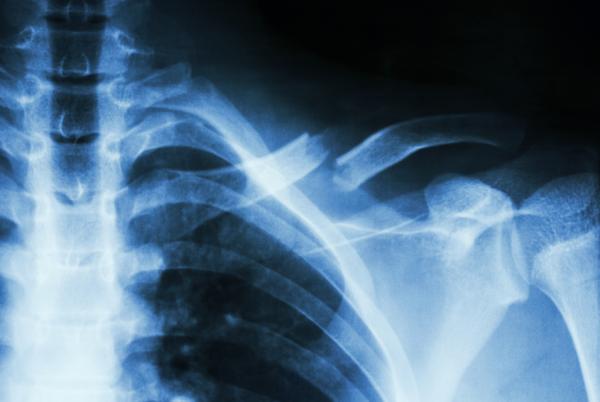 Dolor en la clavícula: causas - Fisura o fractura del hueso clavicular