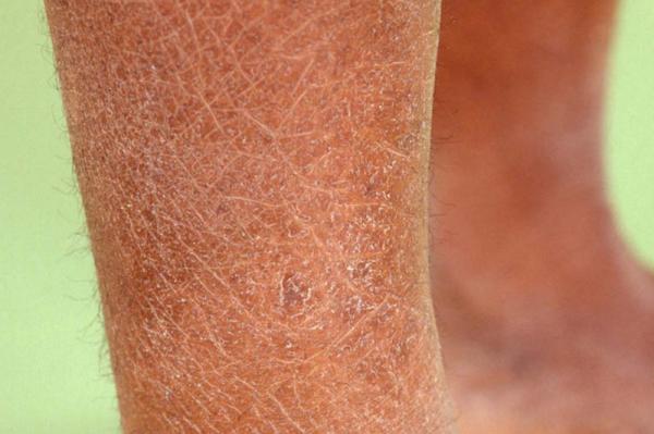 Xerosis cutánea: tratamiento - con fotos - Definición de xerosis cutánea